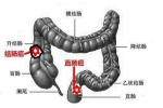 身體出現(xiàn)哪些信號提示直腸癌呢？
